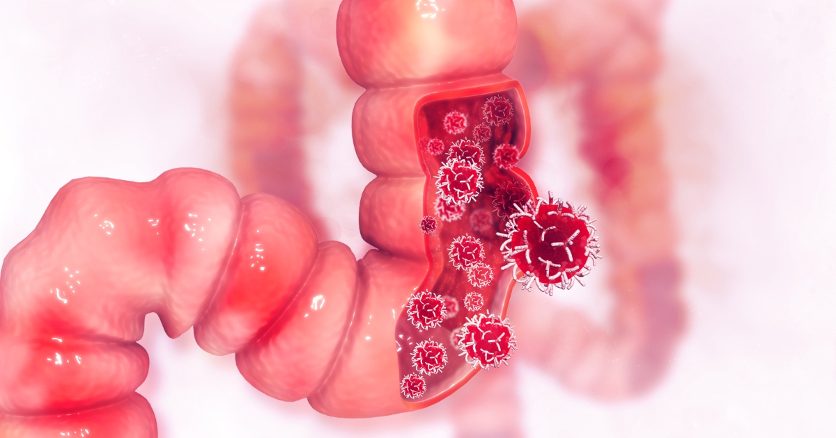 Colon Cancer - Recognizing the Signs
