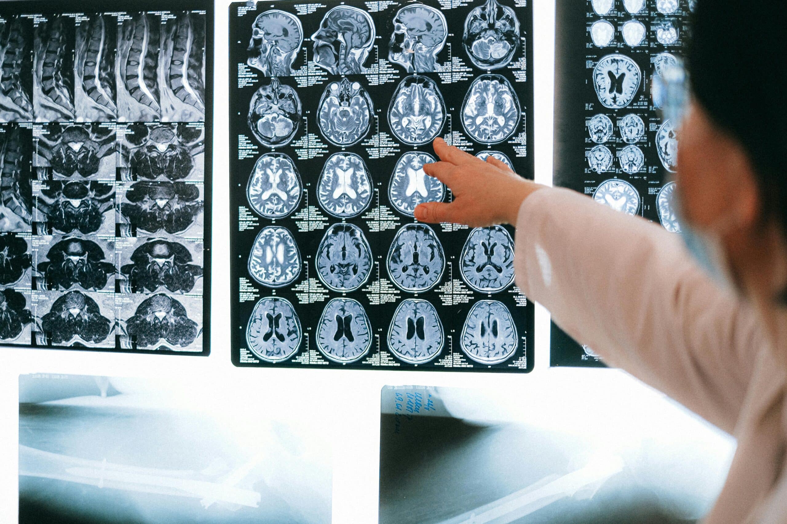Encephalitis