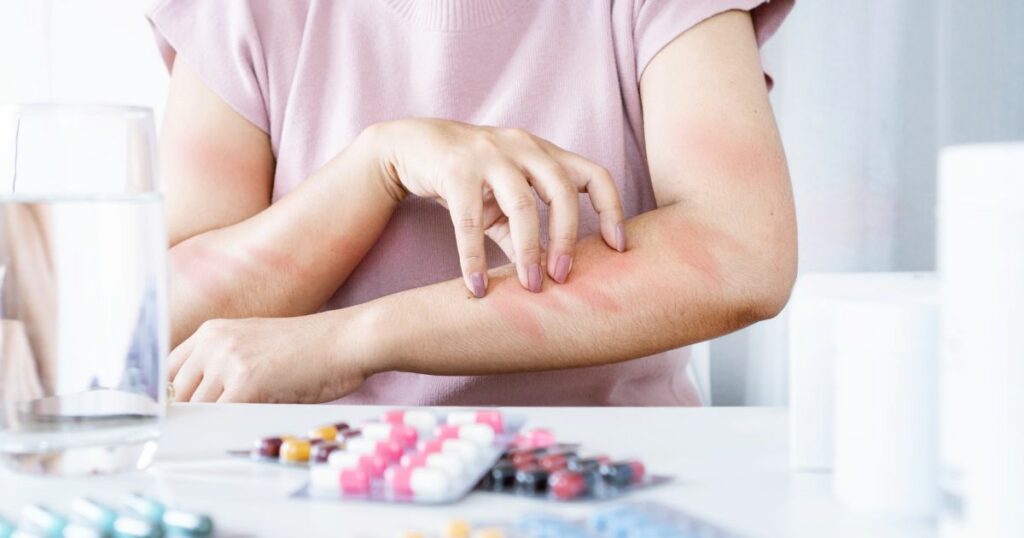 Adverse Effects and Allergic Reactions