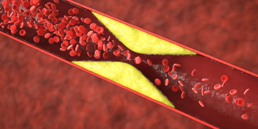 Managing Cholesterol