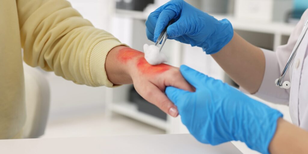 Burns_ Resuscitation in the First 24 Hours